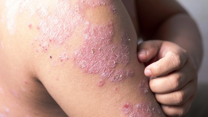 «Los queratinocitos se vuelven locos»: motivo de la descamación por psoriasis