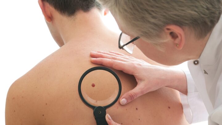 El cáncer de piel crece en Bizkaia: 40% más de diagnósticos desde 2020
