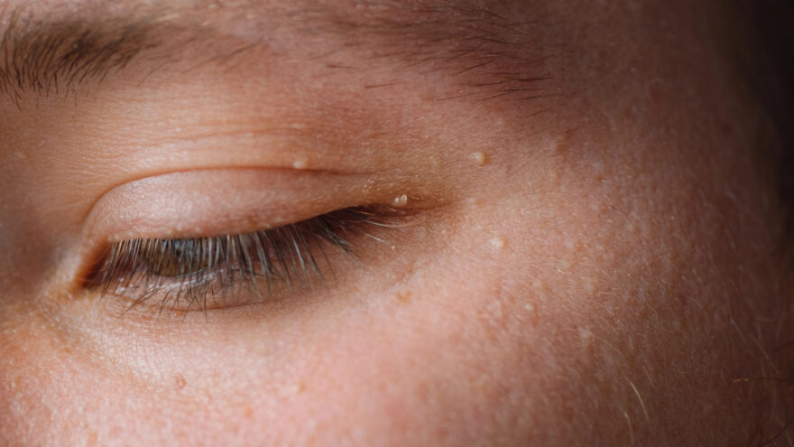 El cáncer también empieza en los ojos