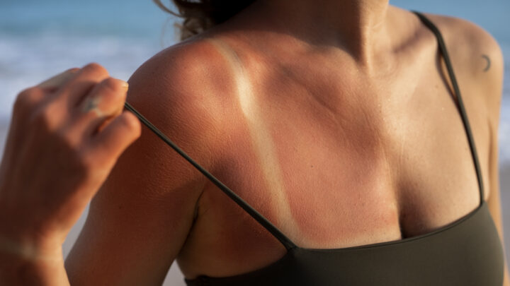 ¿Qué le pasa a la piel cuando nos bronceamos?