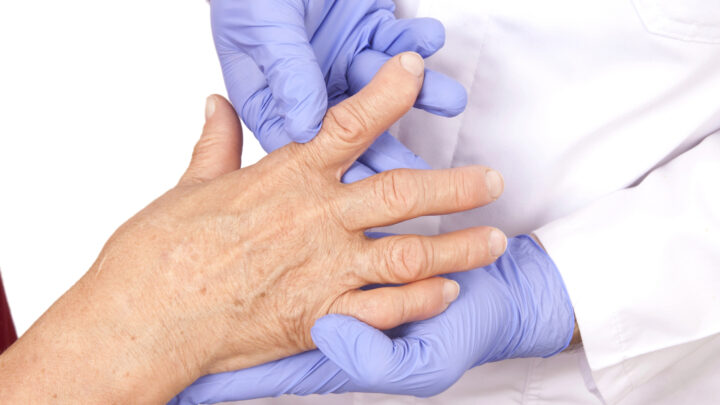 ¿Es posible anticiparse a la artritis reumatoide? Un nuevo tratamiento reduce a la mitad su aparición